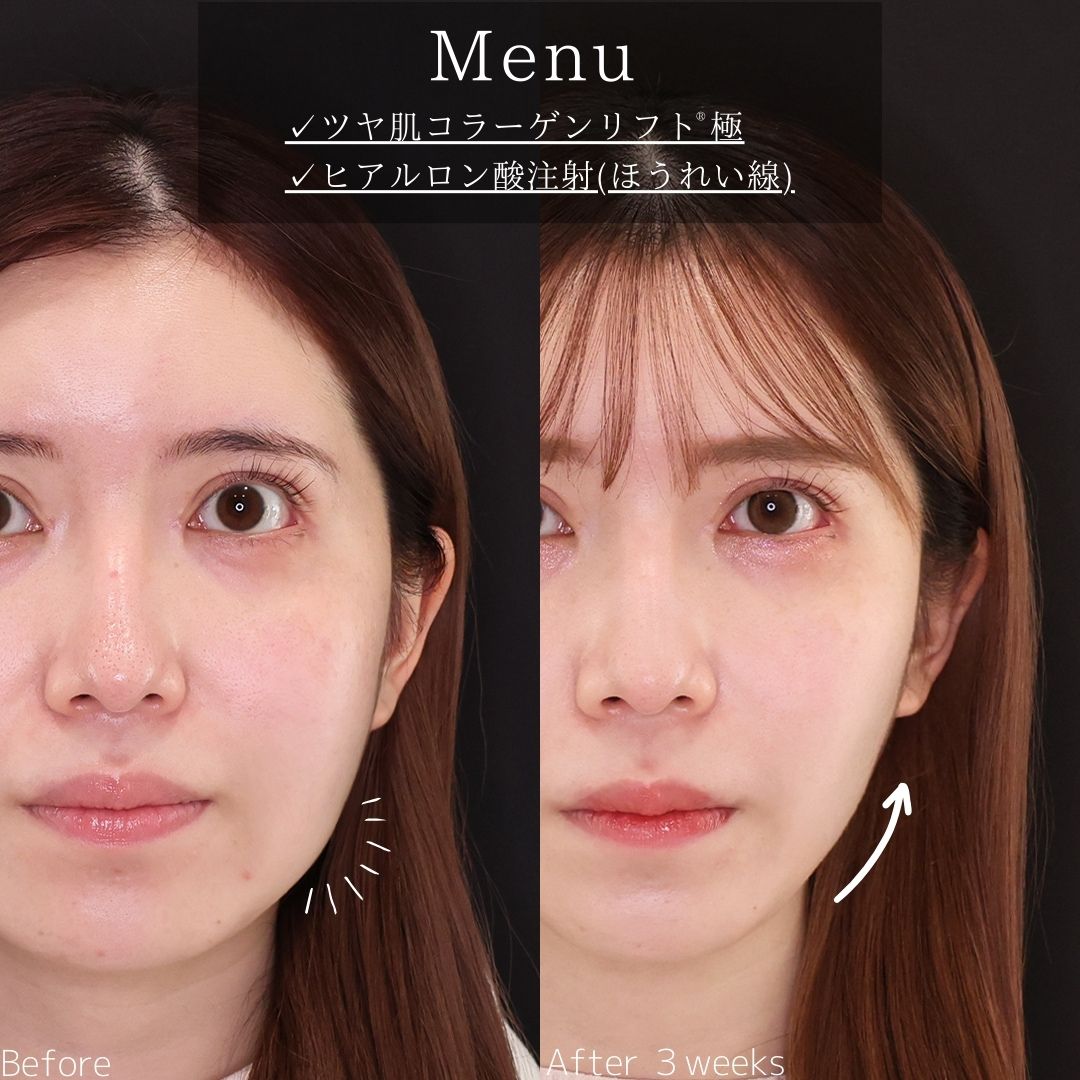 TAC式 ツヤ肌コラーゲンリフト®/ほうれい線のヒアルロン酸注射の症例写真 施術前後 