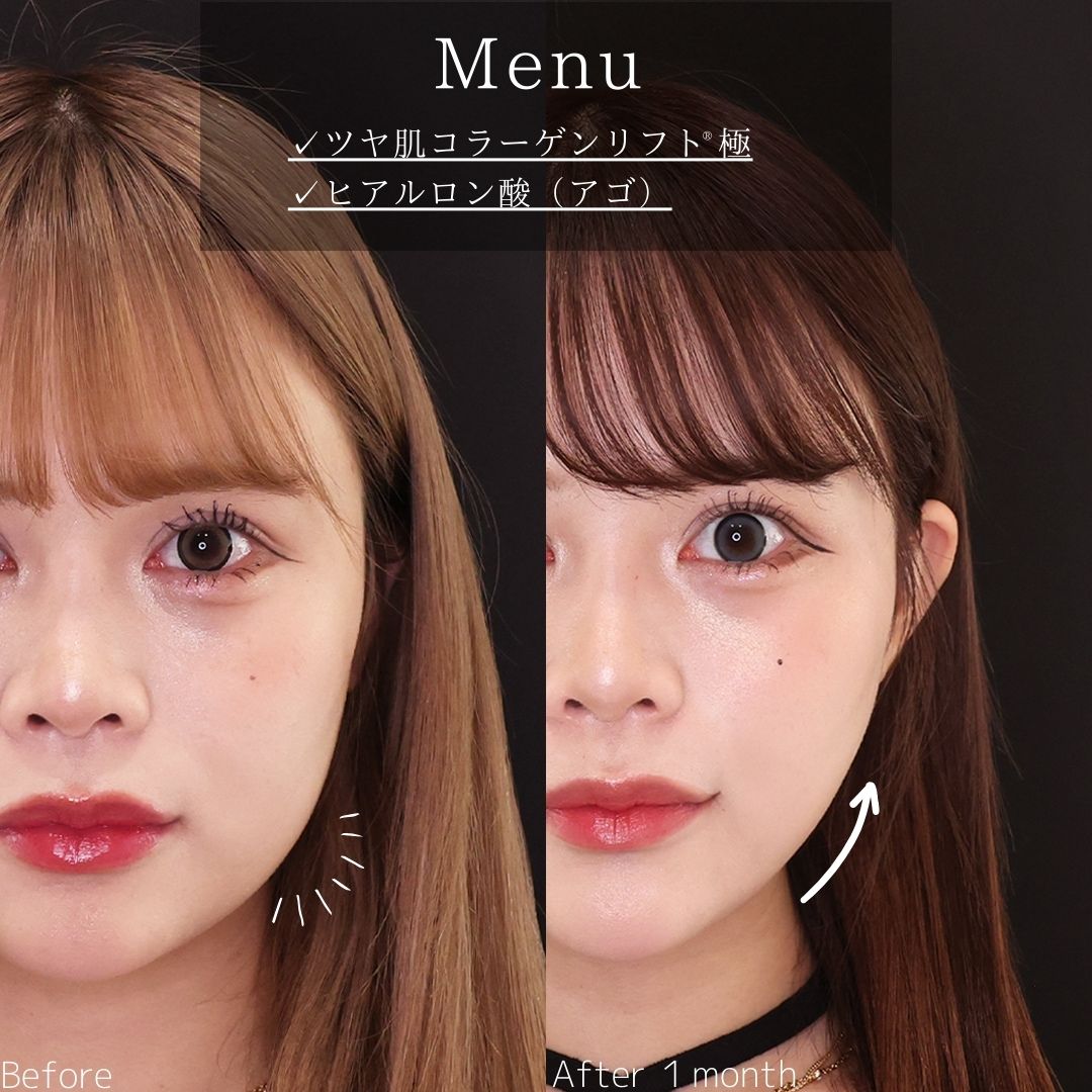 TAC式 ツヤ肌コラーゲンリフト®/顎のヒアルロン酸注射の症例写真 施術前後