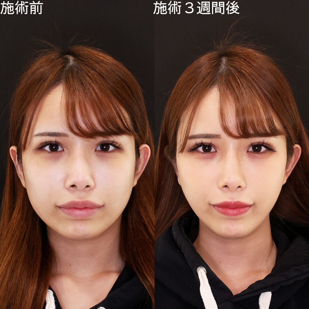 マイルドな変化で洗練！丸顔改善術【糸リフト】