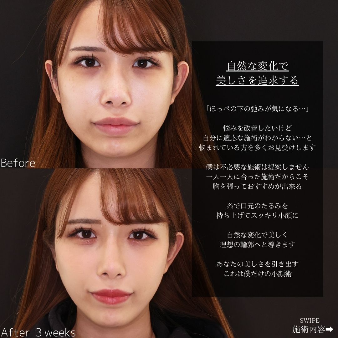 TAC式 ツヤ肌コラーゲンリフト®/エラボトックス注射の症例写真 施術前後 