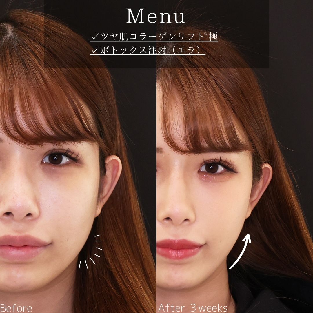TAC式 ツヤ肌コラーゲンリフト®/エラボトックス注射の症例写真 施術前後 