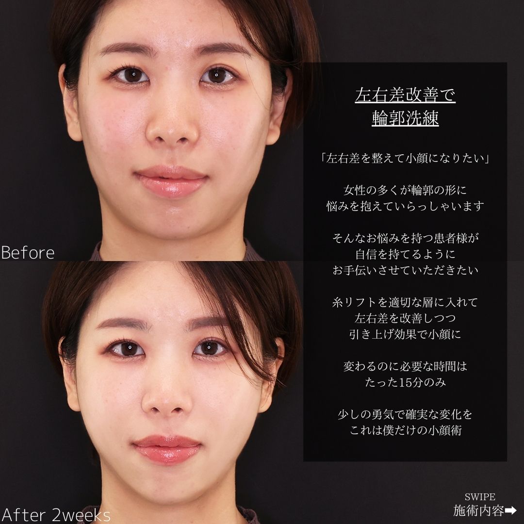 TAC式 ツヤ肌コラーゲンリフト®の症例写真 施術前後 