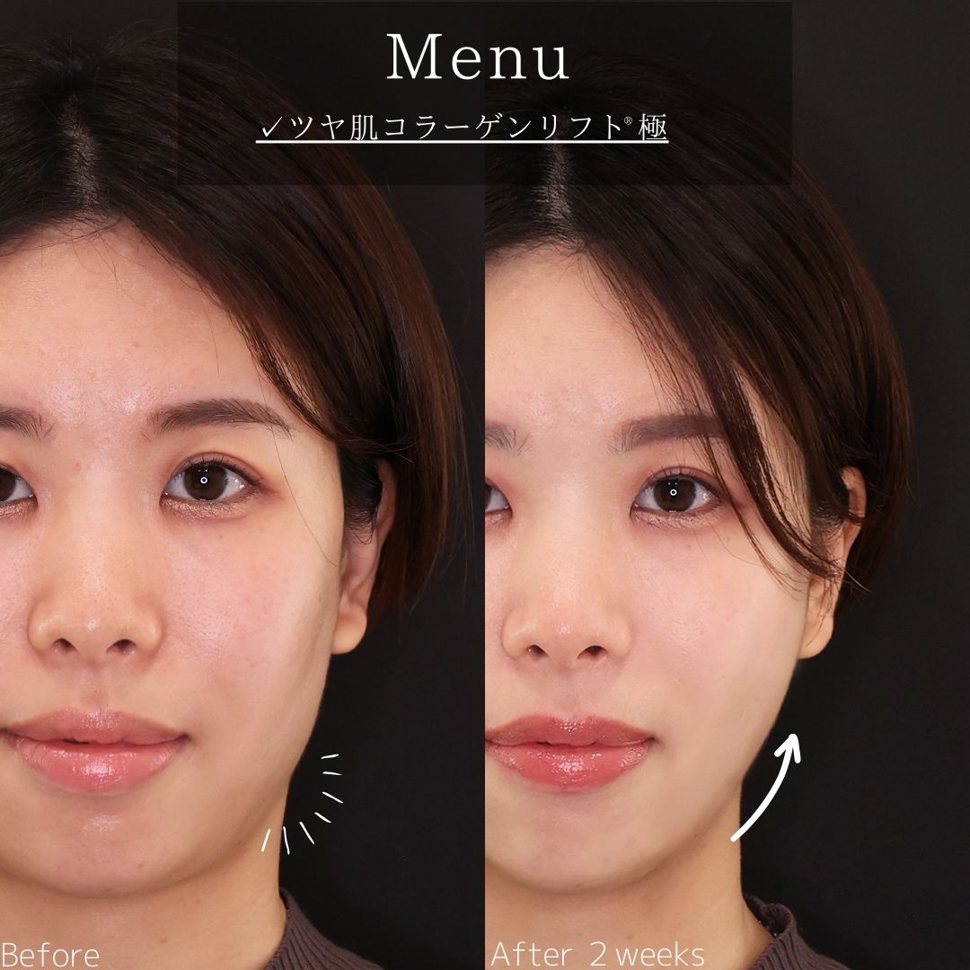 TAC式 ツヤ肌コラーゲンリフト®の症例写真 施術前後 