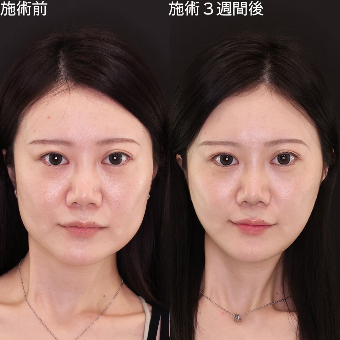 【糸リフト】歪みを整えて垢抜け！憧れの卵型輪郭はつくれる！