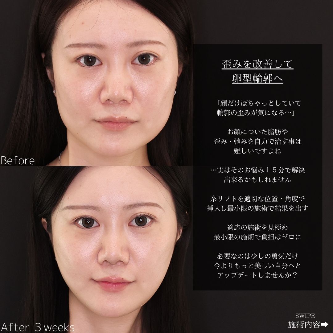 TAC式 ツヤ肌コラーゲンリフト®/エラボトックス注射の症例写真 施術前後 