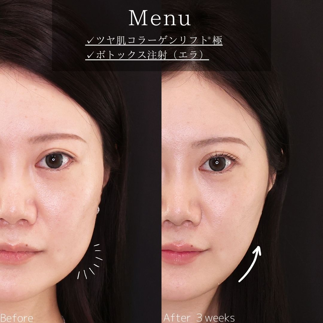 TAC式 ツヤ肌コラーゲンリフト®/エラボトックス注射の症例写真 施術前後 