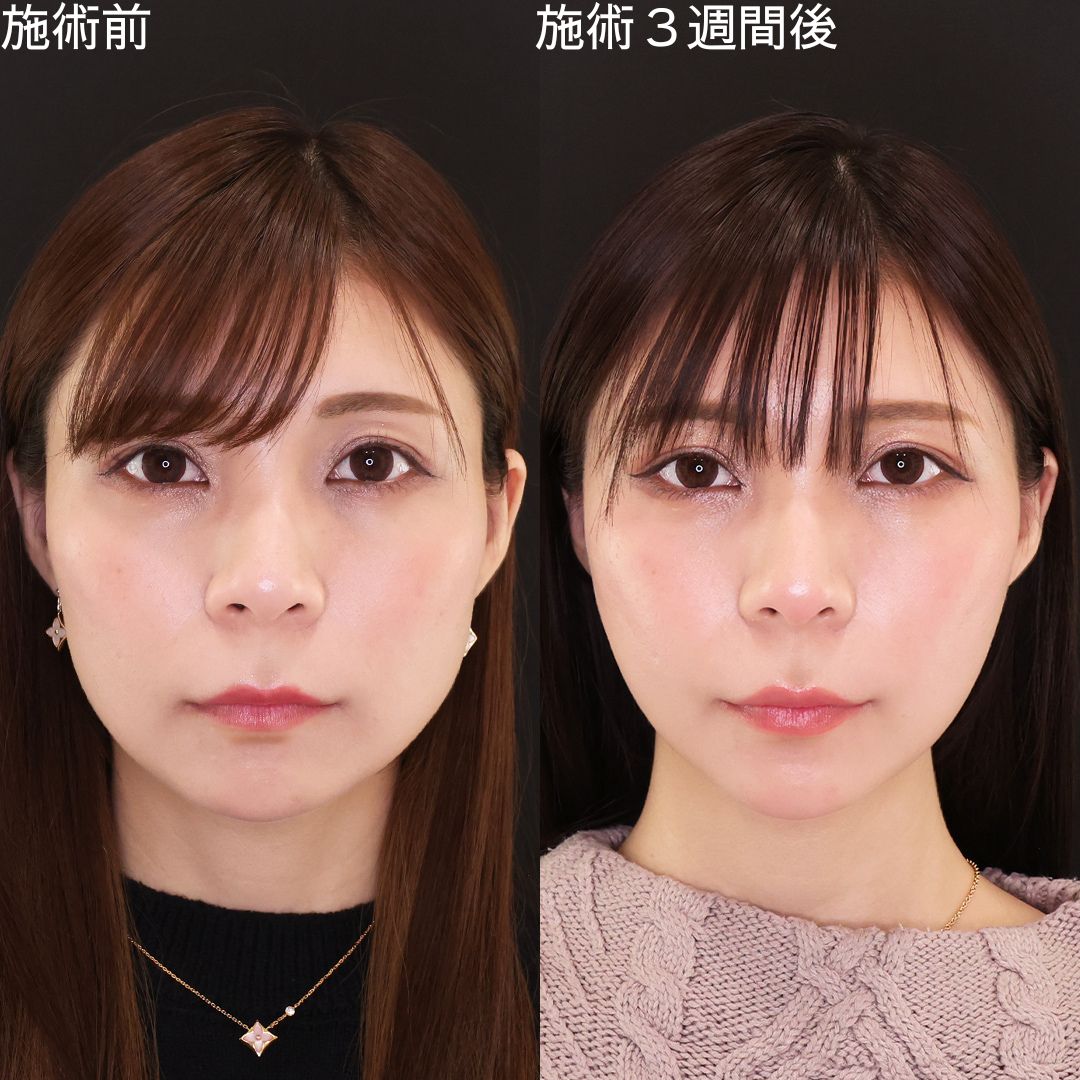 【糸リフト】マイルドな変化で洗練！丸顔改善小顔術
