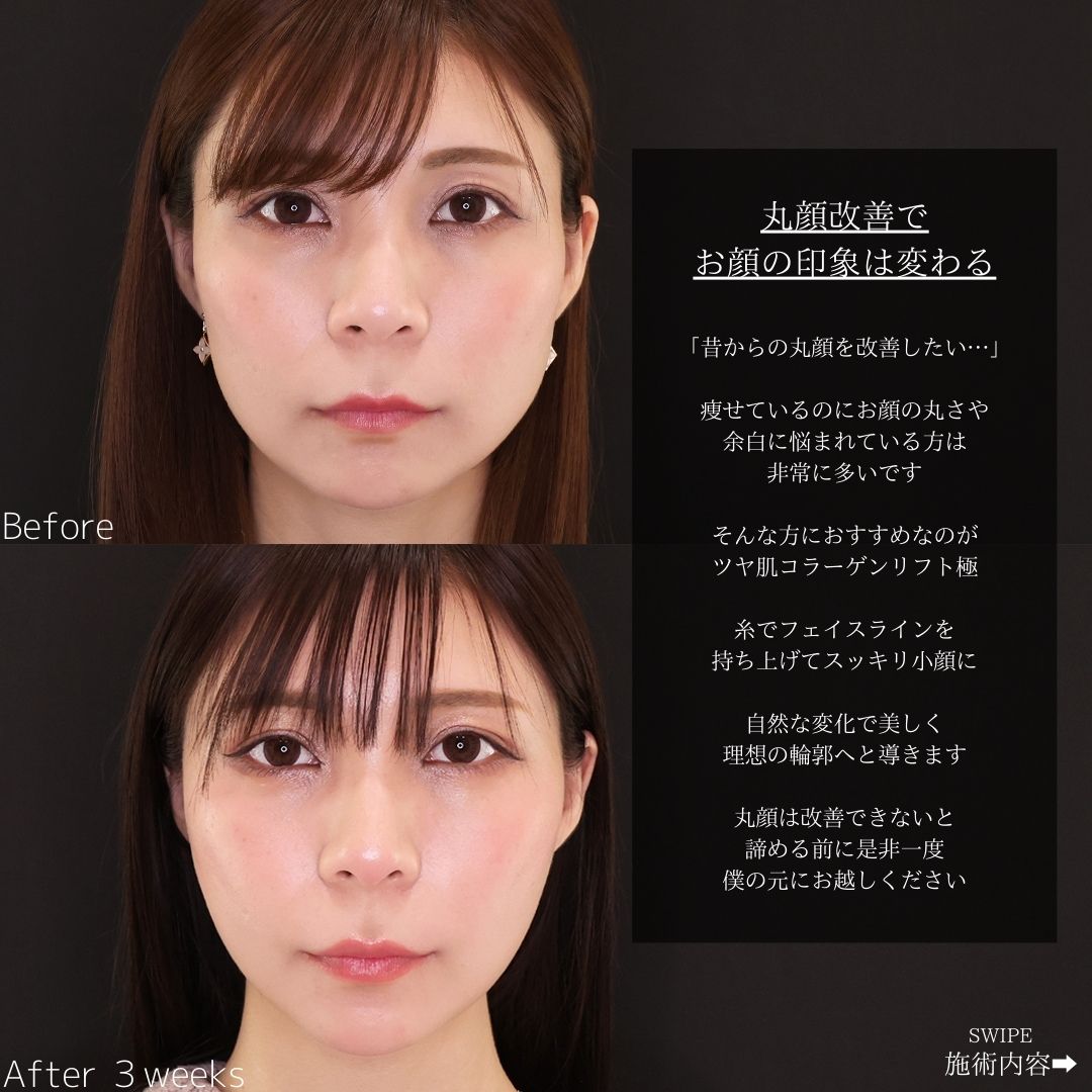 TAC式 ツヤ肌コラーゲンリフト®/エラボトックス注射/ボトックス注射：その他の症例写真 施術前後 