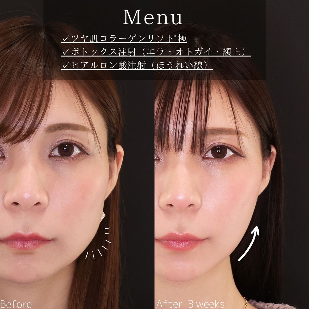 TAC式 ツヤ肌コラーゲンリフト®/エラボトックス注射/ボトックス注射：その他の症例写真 施術前後 