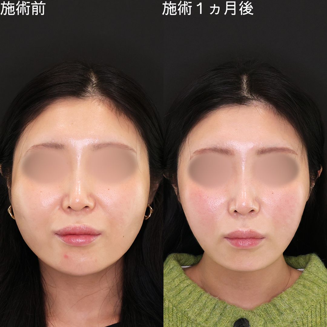 確実なボリュームダウンで印象激変【小顔複合術】