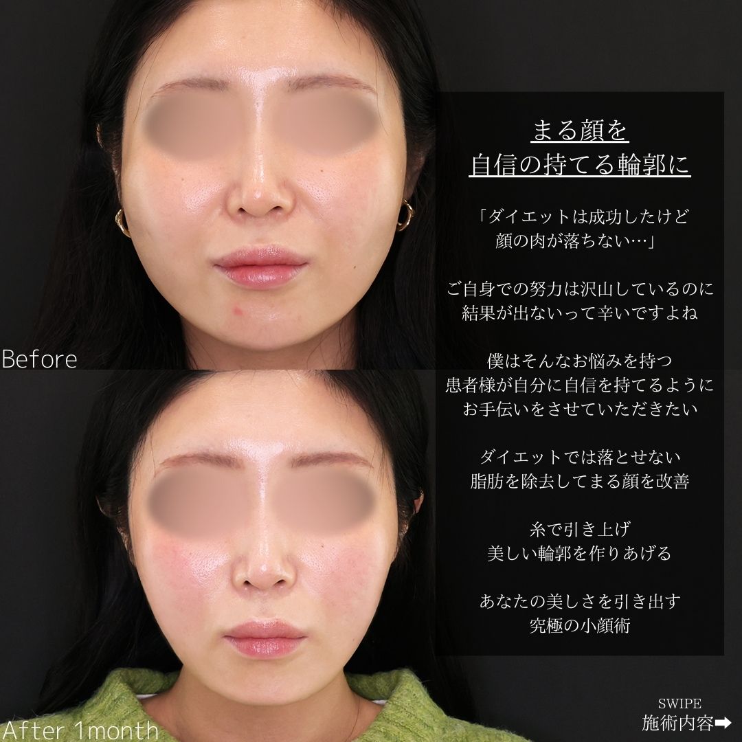 TAC式 ツヤ肌コラーゲンリフト®/ジョールファット除去の症例写真 施術前後 