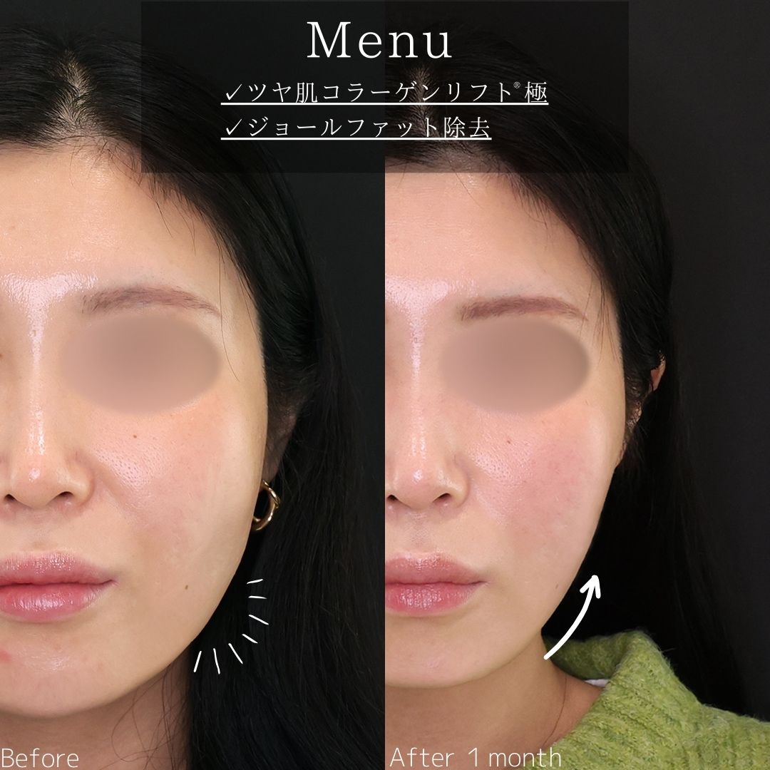 TAC式 ツヤ肌コラーゲンリフト®/ジョールファット除去の症例写真 施術前後 