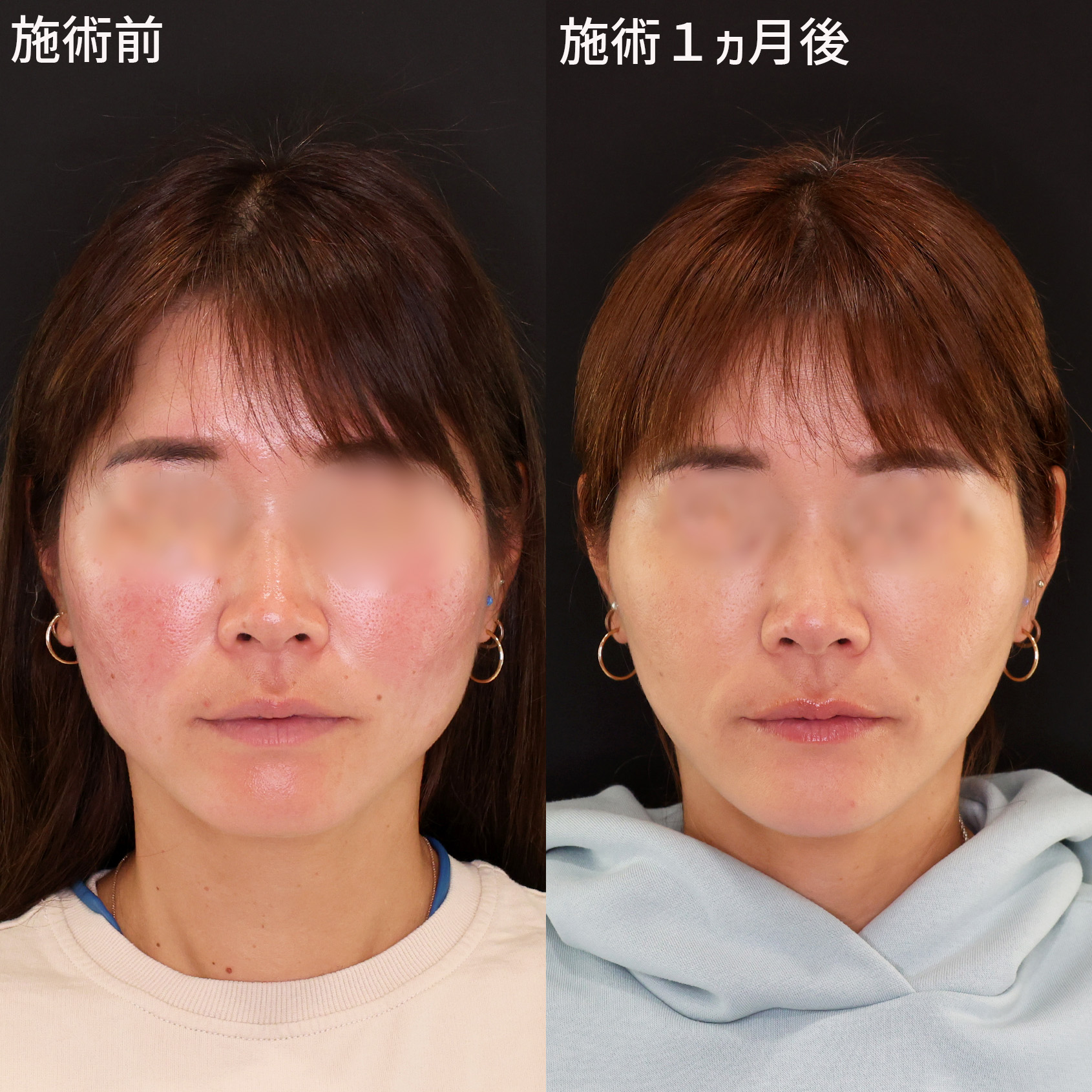 【糸リフト】どこから見ても美しい卵型美輪郭に