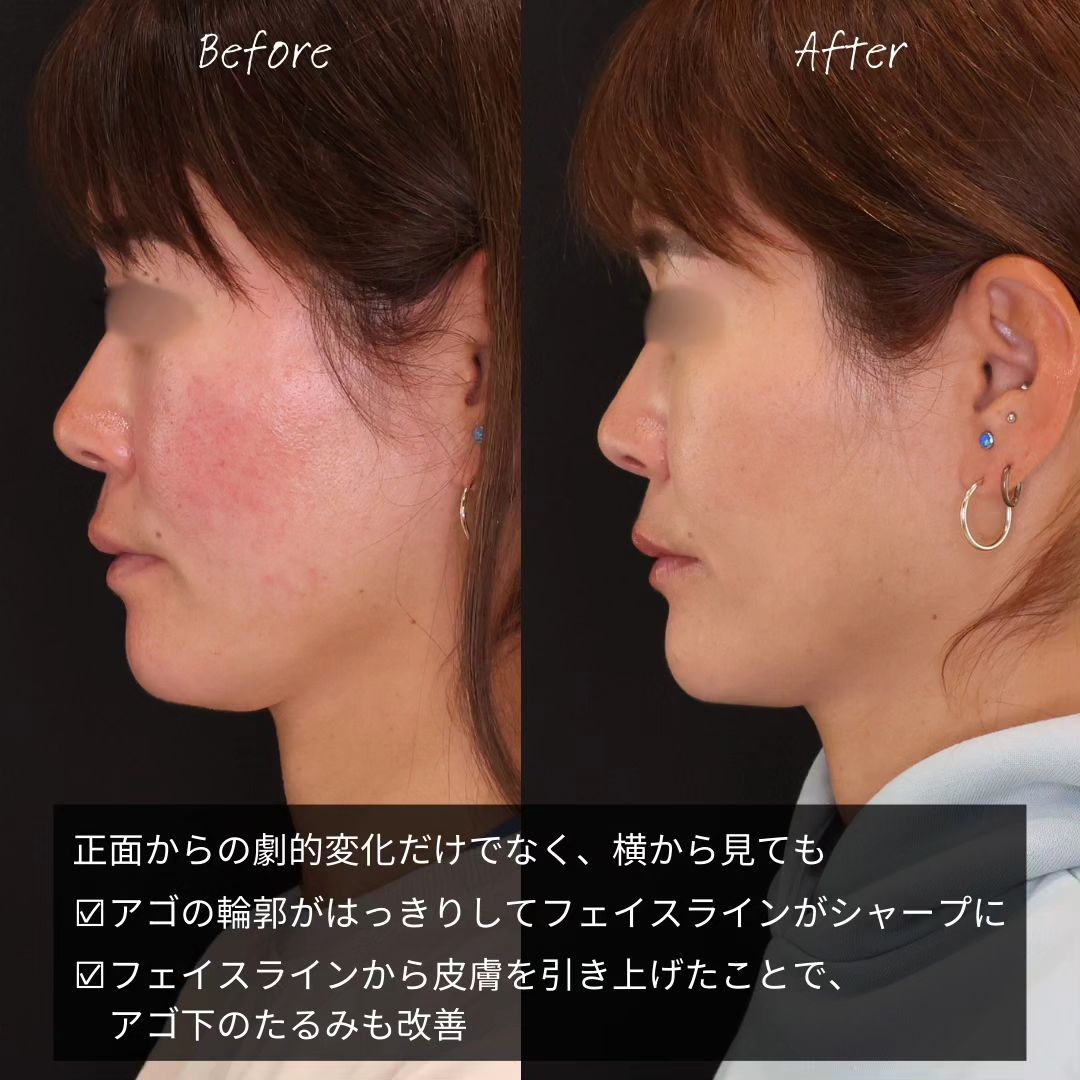 TAC式 ツヤ肌コラーゲンリフト®/TAC式 ショッピングリフト/顎のヒアルロン酸注射の症例写真 施術前後 