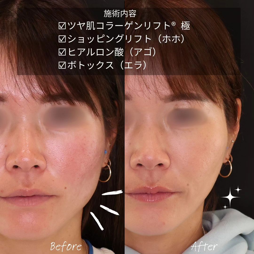 TAC式 ツヤ肌コラーゲンリフト®/TAC式 ショッピングリフト/顎のヒアルロン酸注射の症例写真 施術前後 