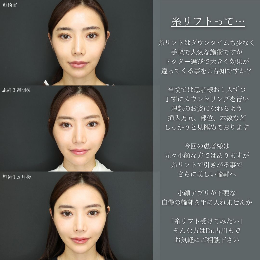 TAC式 ツヤ肌コラーゲンリフト®/ほうれい線のヒアルロン酸注射/顎のヒアルロン酸注射の症例写真 施術前後 