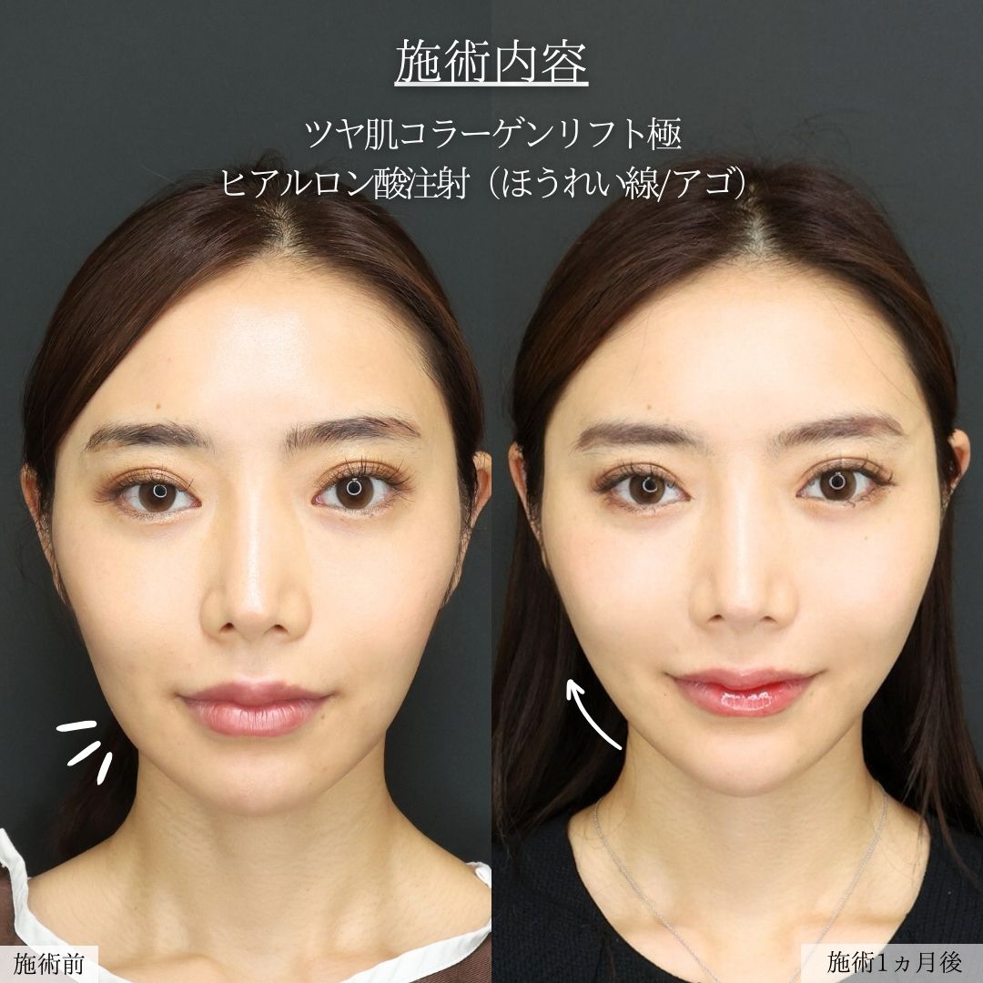 TAC式 ツヤ肌コラーゲンリフト®/ほうれい線のヒアルロン酸注射/顎のヒアルロン酸注射の症例写真 施術前後 