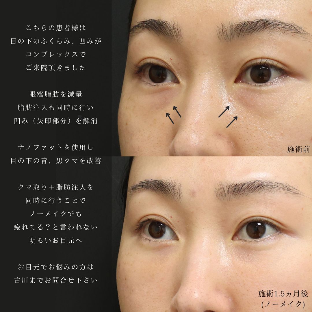 下眼瞼脱脂術（目の下のたるみ取り・目の下の脂肪ふくらみ取り）の症例写真 施術前後 