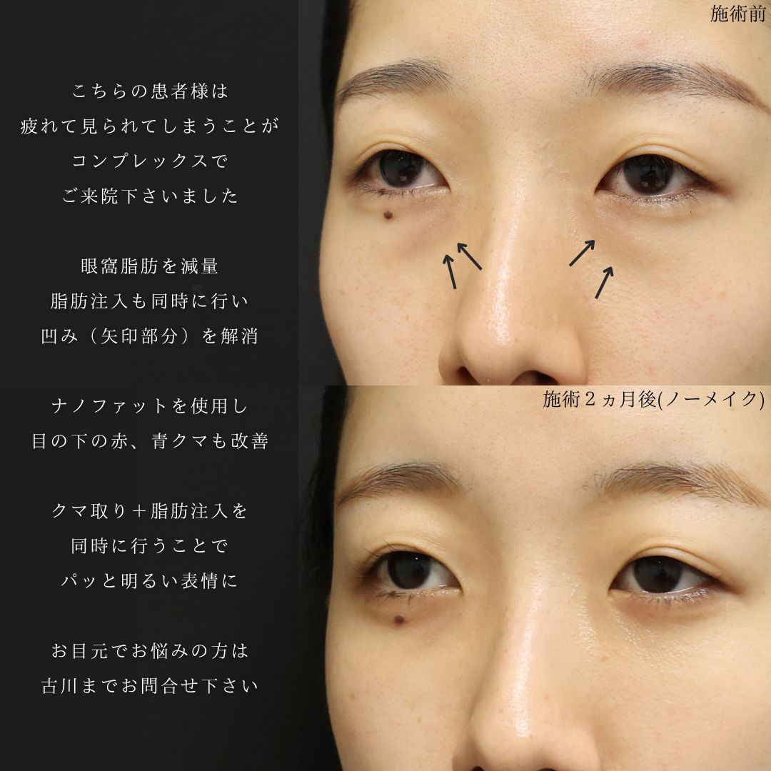 下眼瞼脱脂術(目の下のたるみ取り・目の下の脂肪ふくらみ取り)の症例写真 施術前後