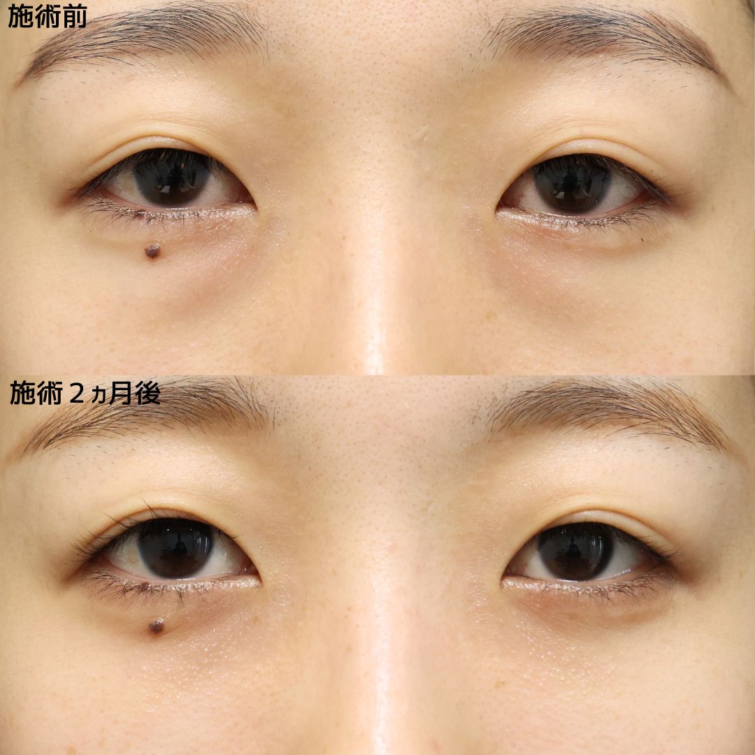 下眼瞼脱脂術(目の下のたるみ取り・目の下の脂肪ふくらみ取り)の症例写真 施術前後