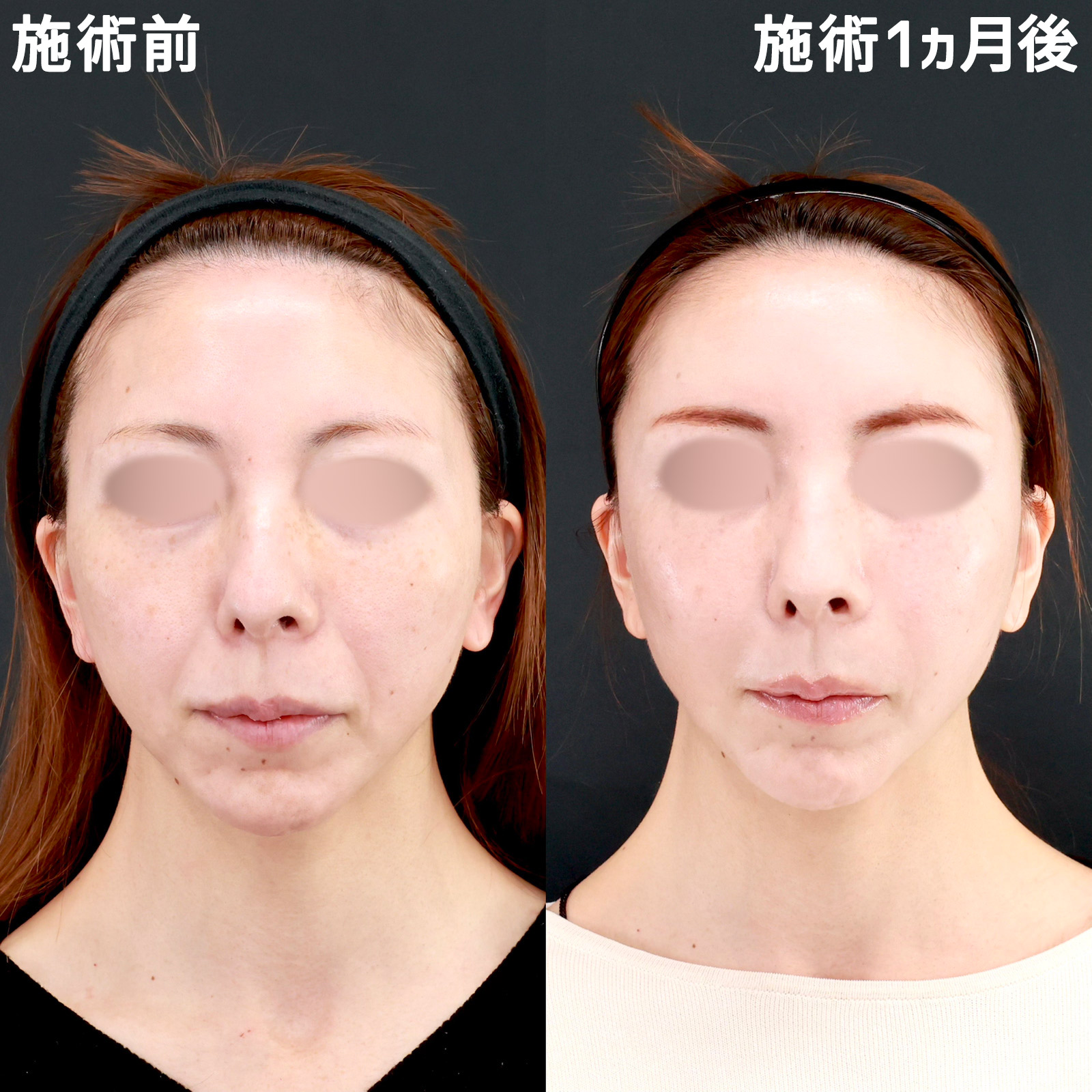 【全顔脂肪注入】ゴツゴツした印象を柔らかく、さらに女性らしい印象に