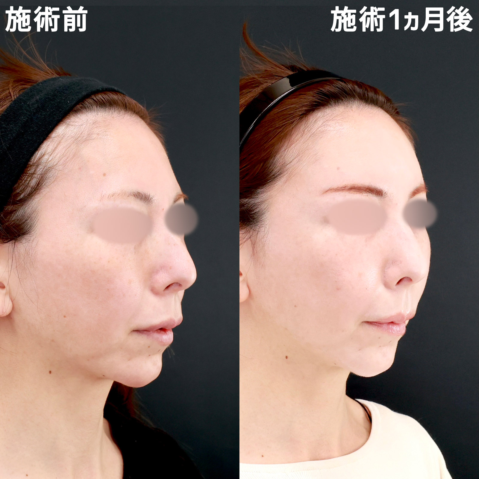 顔の脂肪注入(コンデンスリッチフェイス)の症例写真 施術前後 