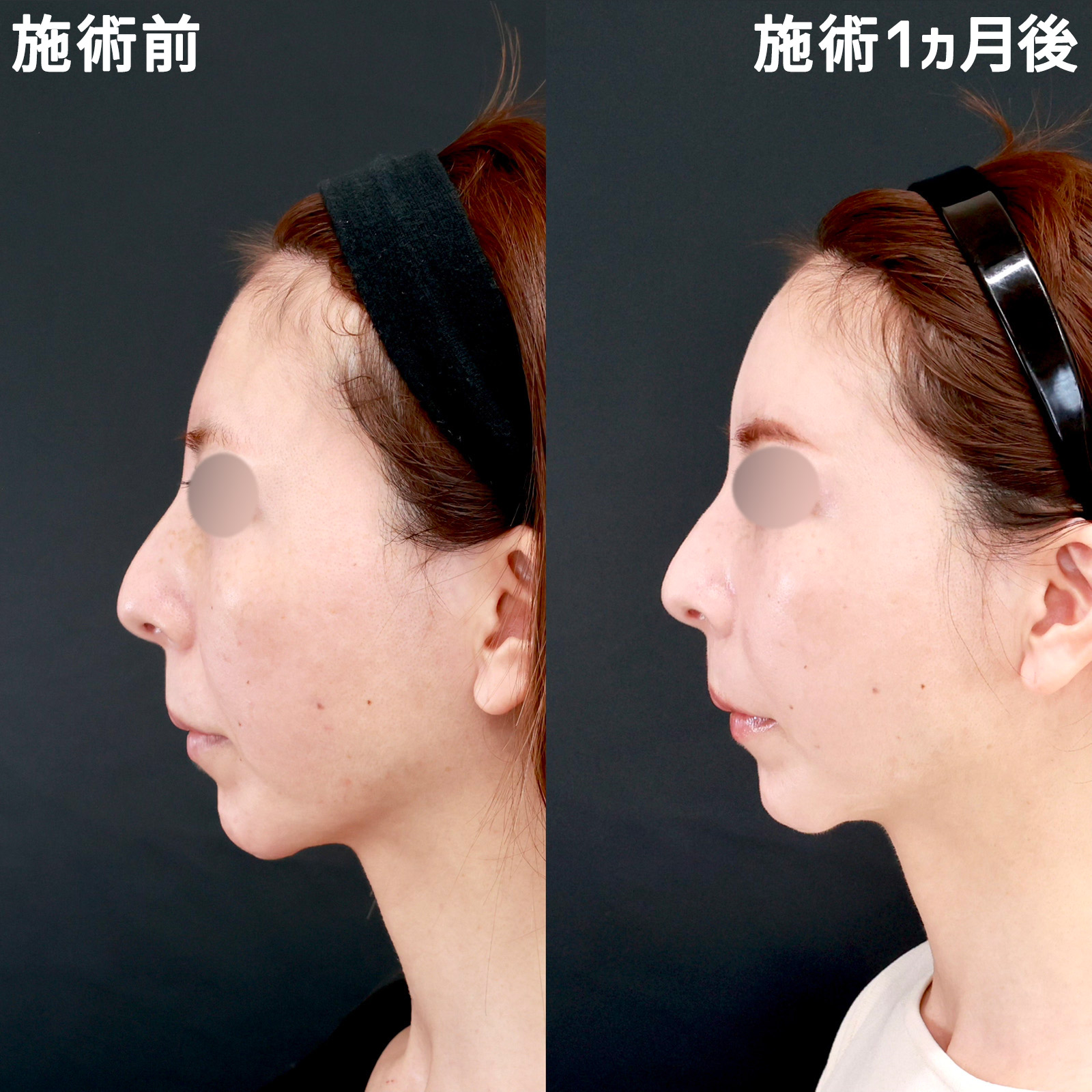 顔の脂肪注入(コンデンスリッチフェイス)の症例写真 施術前後 