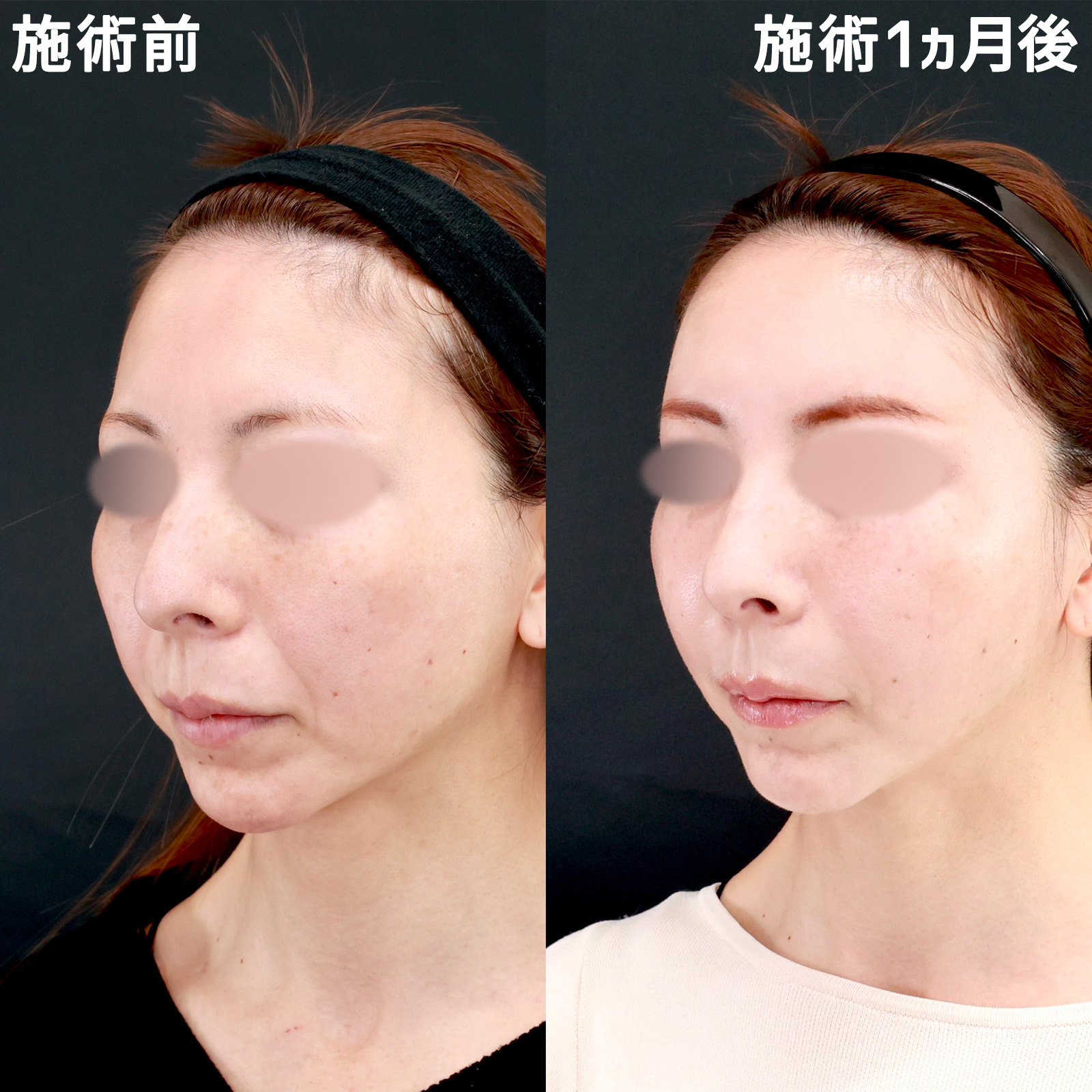 顔の脂肪注入(コンデンスリッチフェイス)の症例写真 施術前後 