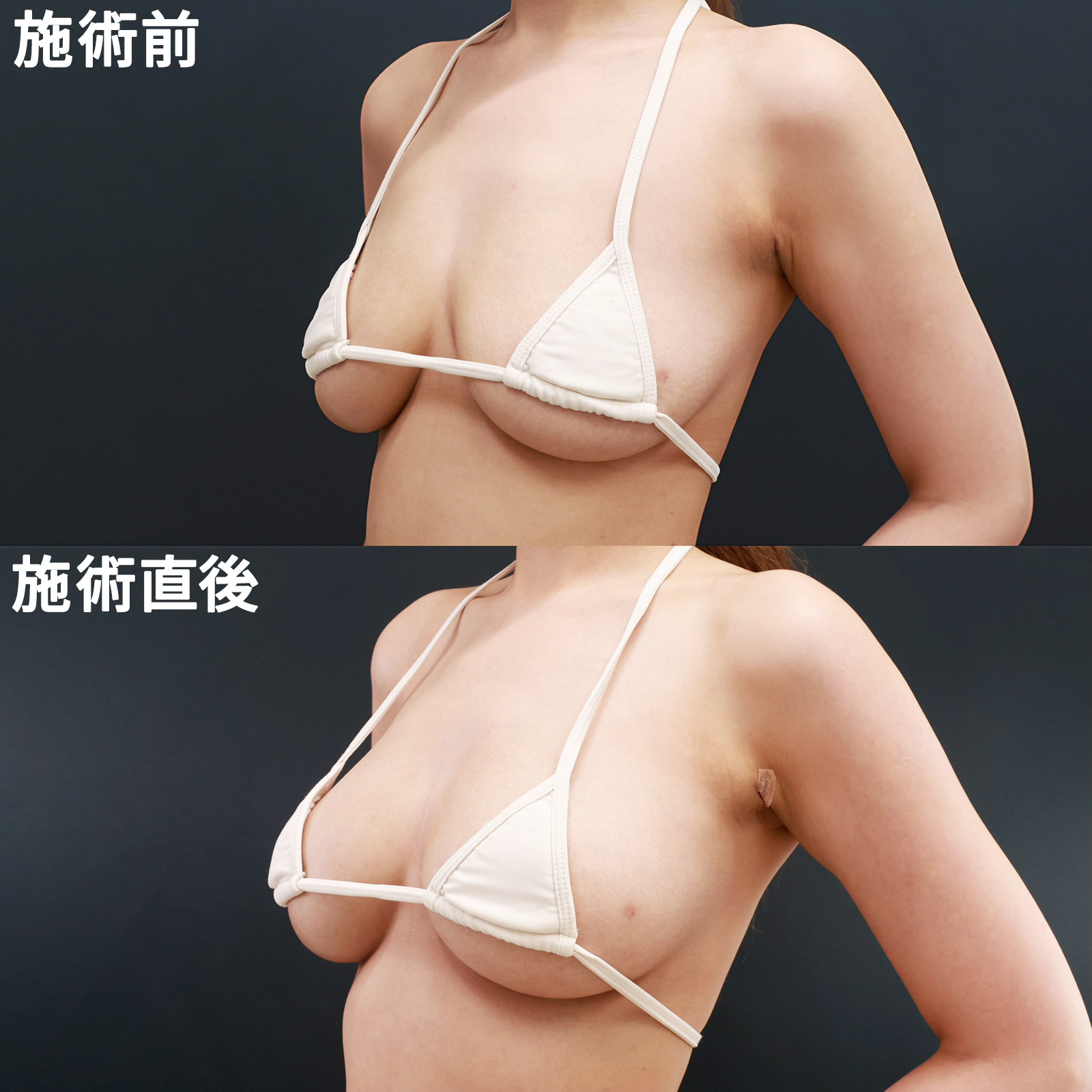 ヒアルロン酸注入豊胸術（グラビアバスト）の症例写真 施術前後 