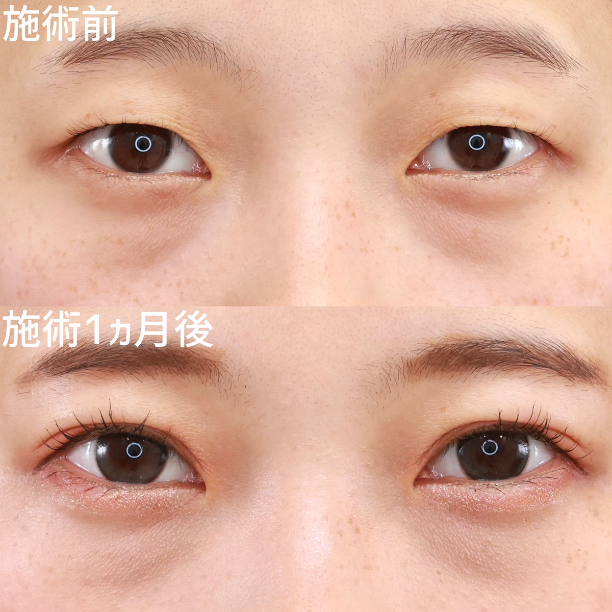 【クイックコスメリング】バレにくい二重整形で劇的に垢抜ける！