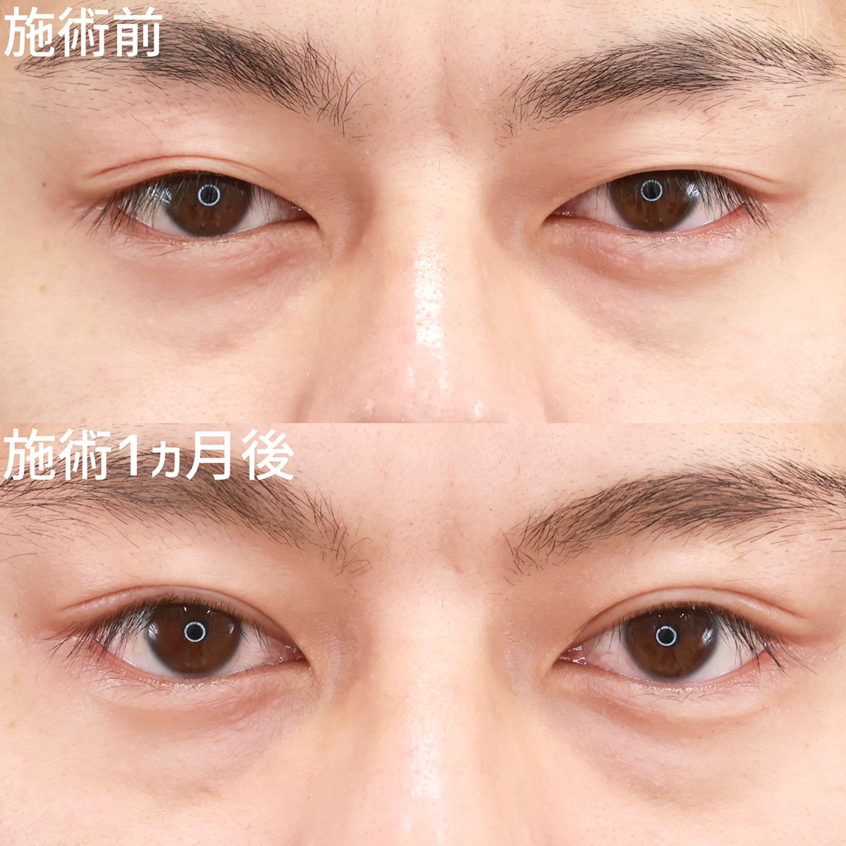 二重埋没法の症例写真 施術前後 