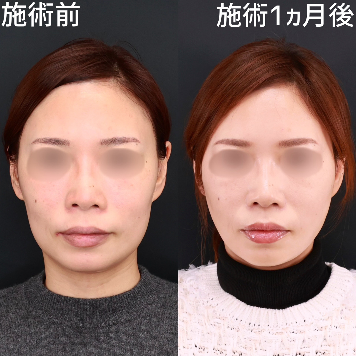 TAC式 ツヤ肌コラーゲンリフト®の症例写真 施術前後