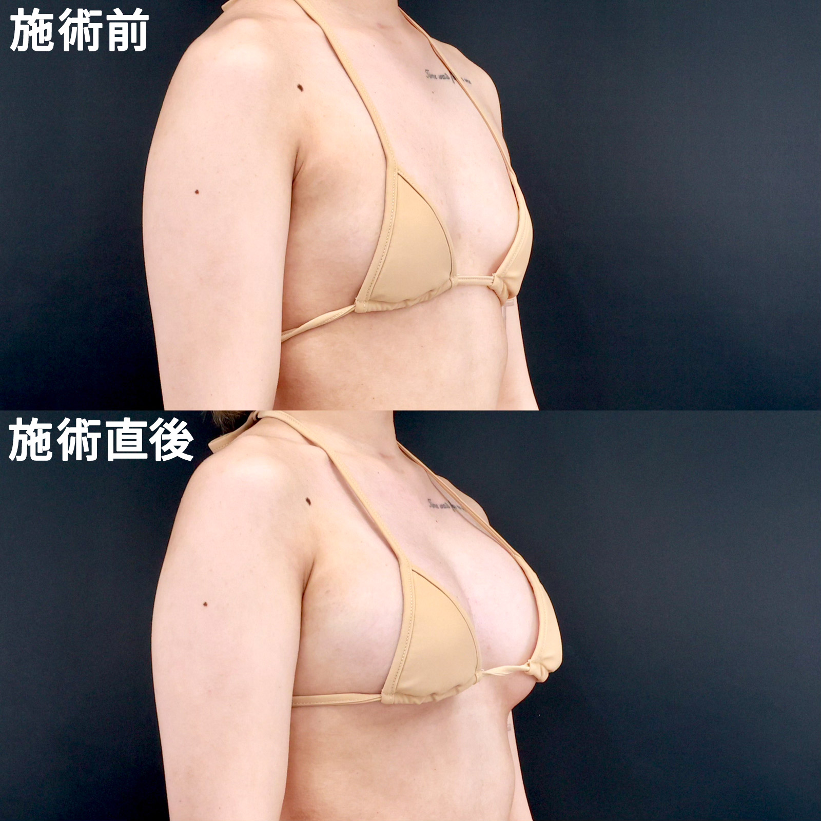 【ヒアルロン酸豊胸】ダウンタイムの取れない方にお勧め!直後から理想の美バストに