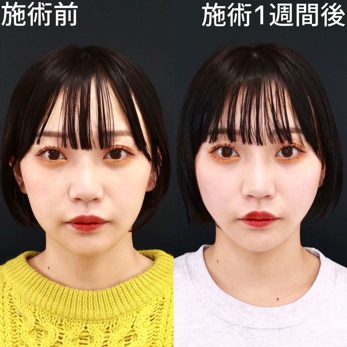 【糸リフト極】口元のもたつき、まるで無かったかのようなスッキリ感！