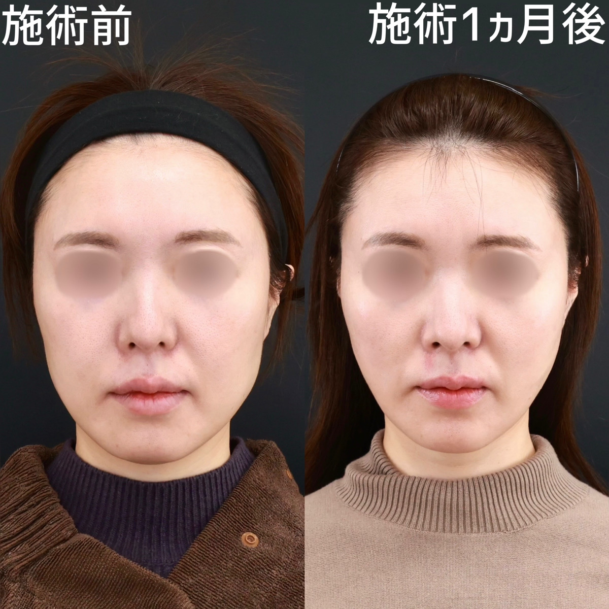 小顔整形|パーフェクトフェイスライン/TAC式 ツヤ肌コラーゲンリフト®/顔の脂肪吸引の症例写真 施術前後