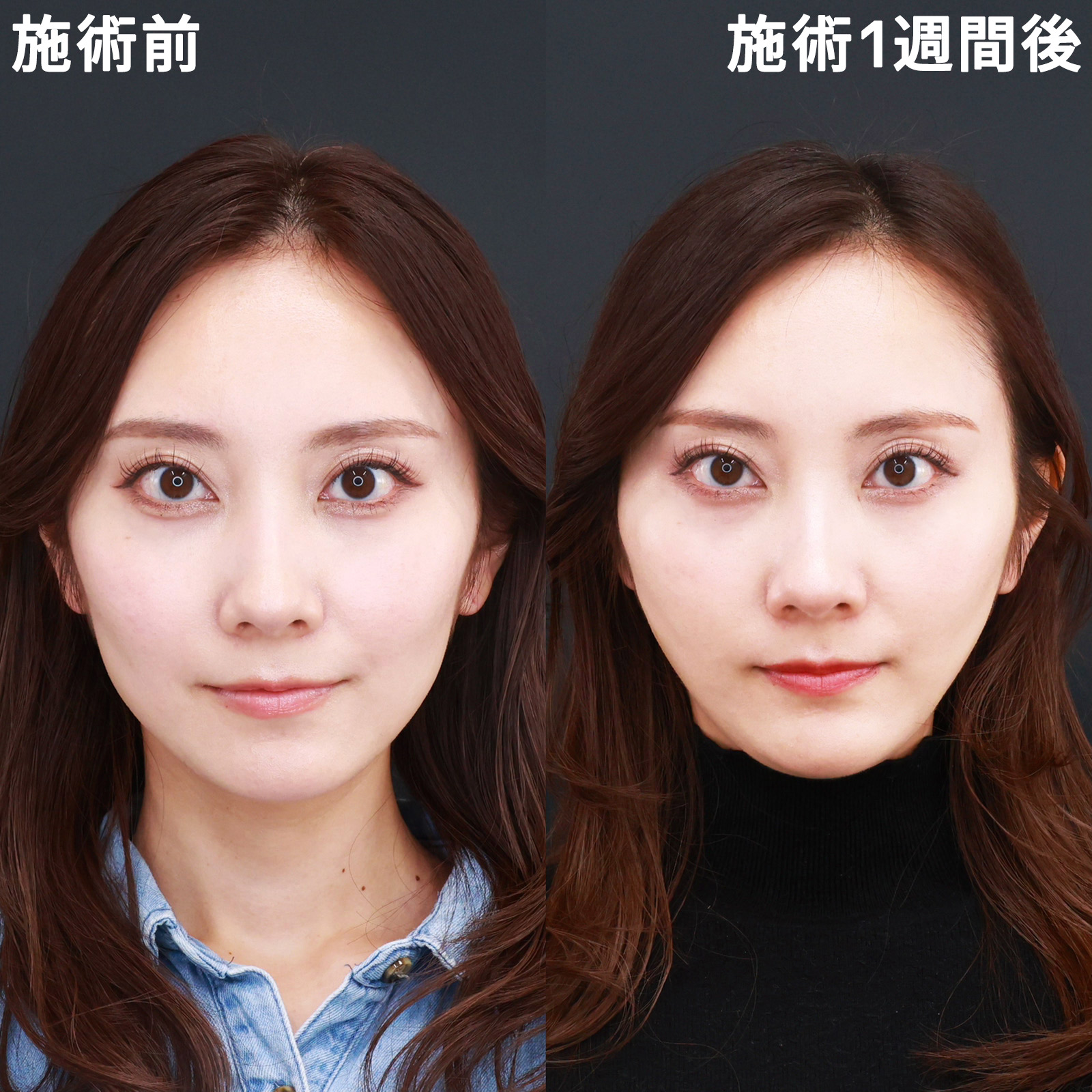 【糸リフト極】角張った輪郭を、より美しい卵型の輪郭にアップデート！