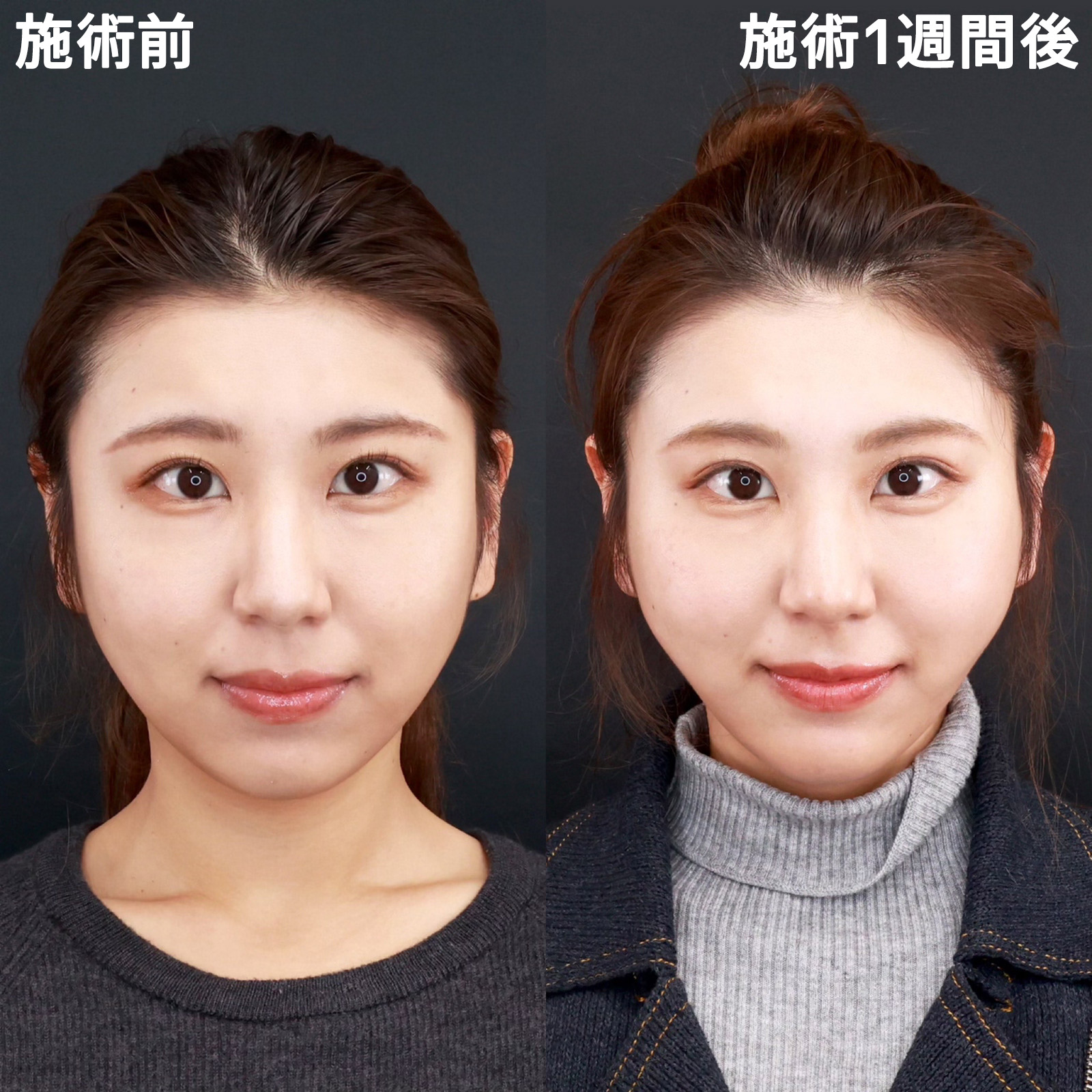 【ジョールファット除去】口周りのもたつき改善！アプリ加工級のVラインフェイスに