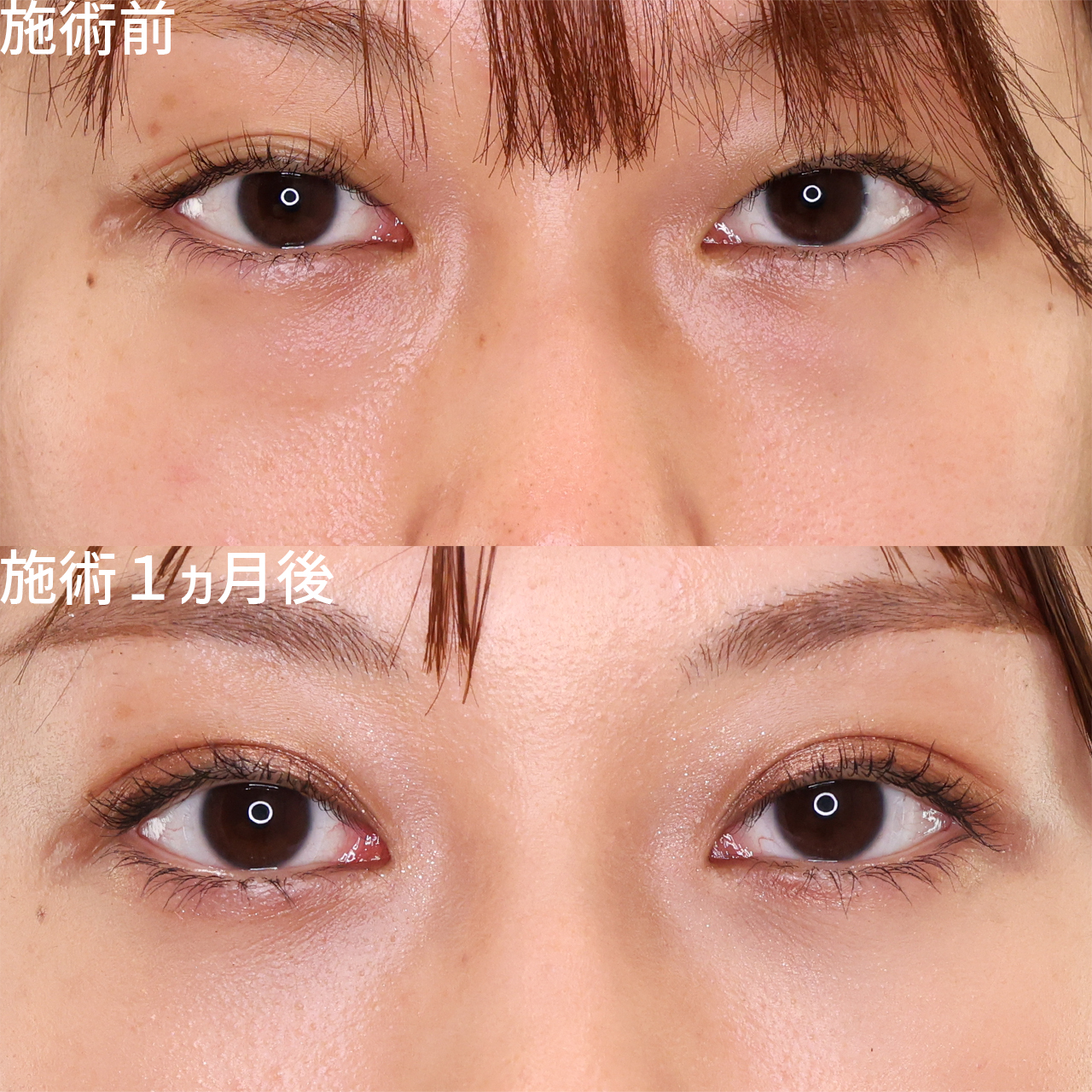 【二重埋没×クマ取り】目元のW施術で2ランク上の自分に