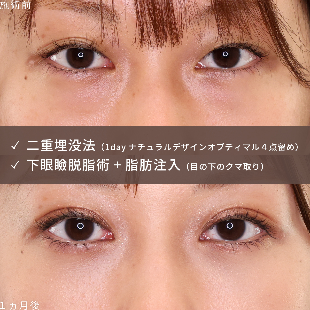 二重埋没法/下眼瞼脱脂術（目の下のたるみ取り・目の下の脂肪ふくらみ取り）の症例写真 施術前後 