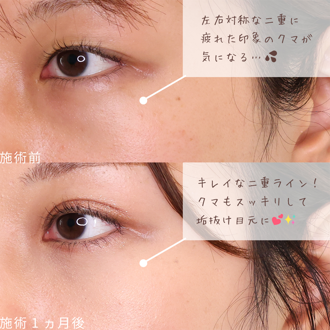 二重埋没法/下眼瞼脱脂術（目の下のたるみ取り・目の下の脂肪ふくらみ取り）の症例写真 施術前後 