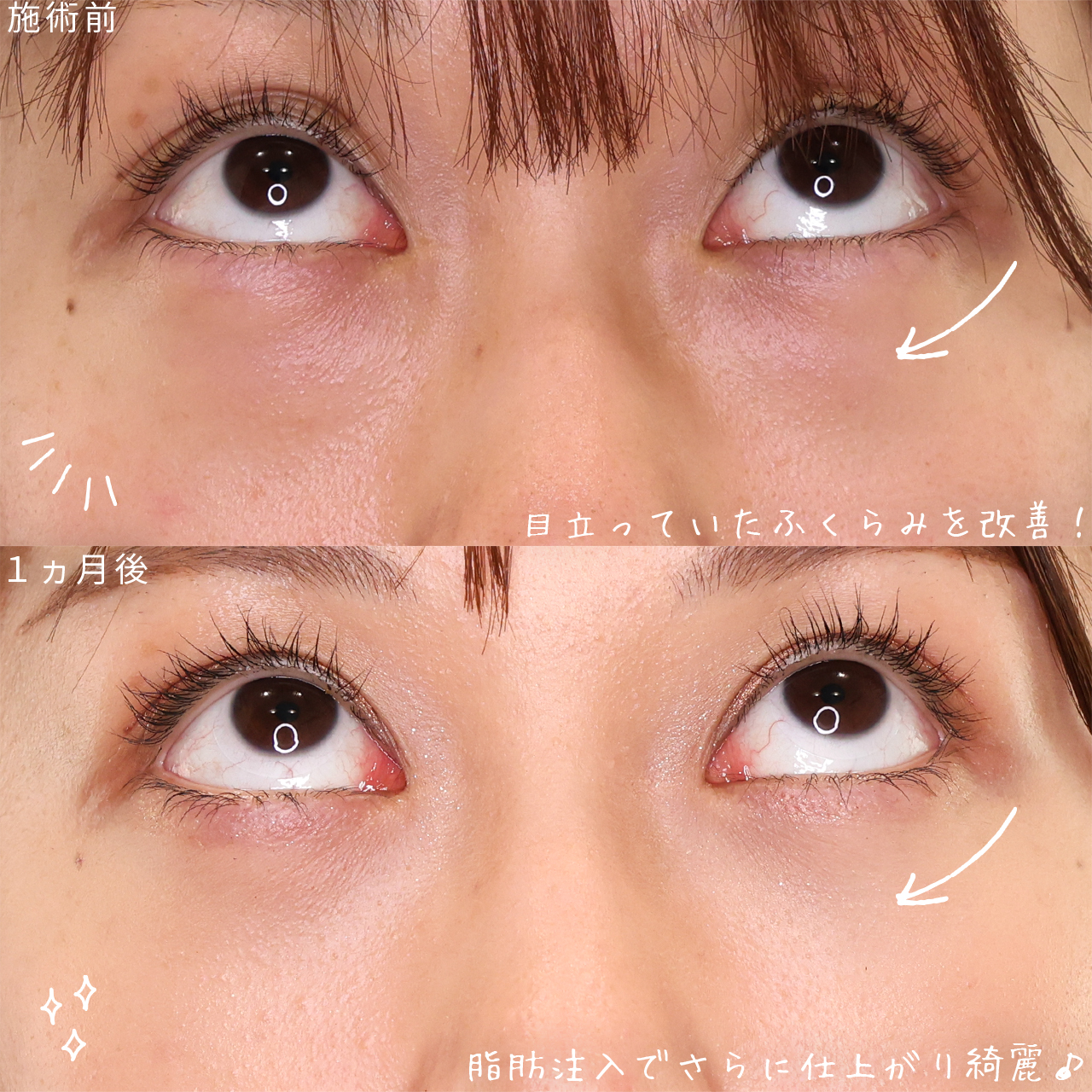 二重埋没法/下眼瞼脱脂術（目の下のたるみ取り・目の下の脂肪ふくらみ取り）の症例写真 施術前後 