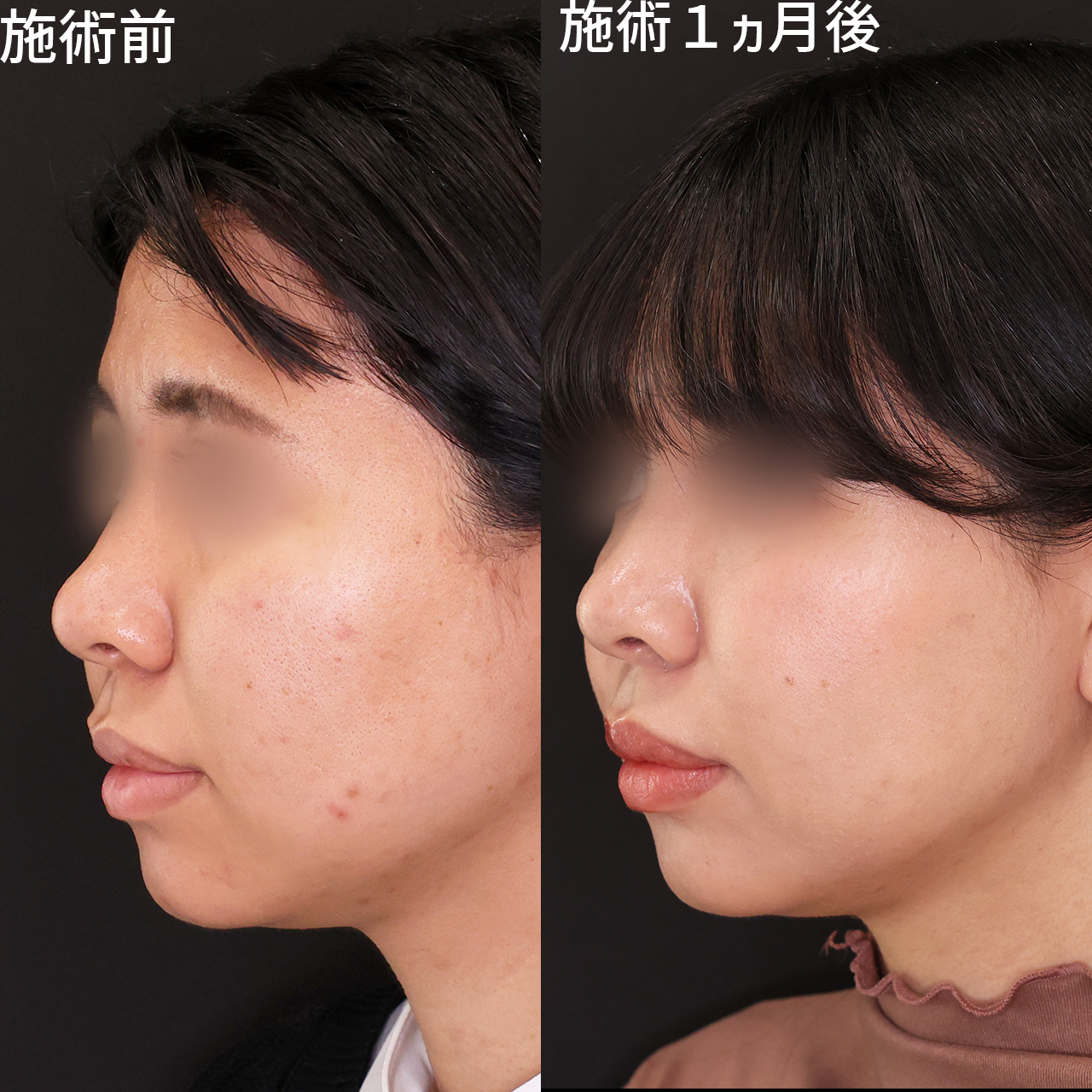 脂肪 のっぺりの症例写真・画像・ビフォーアフター｜美容整形