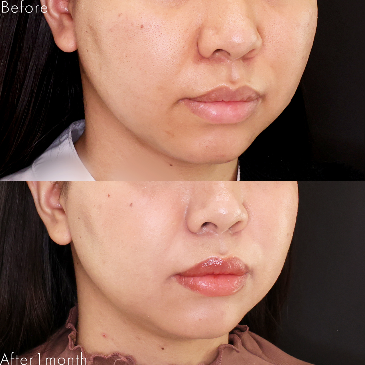 貴族手術(鼻翼基部プロテーゼ・脂肪注入・粉砕肋軟骨移植)の症例写真 施術前後