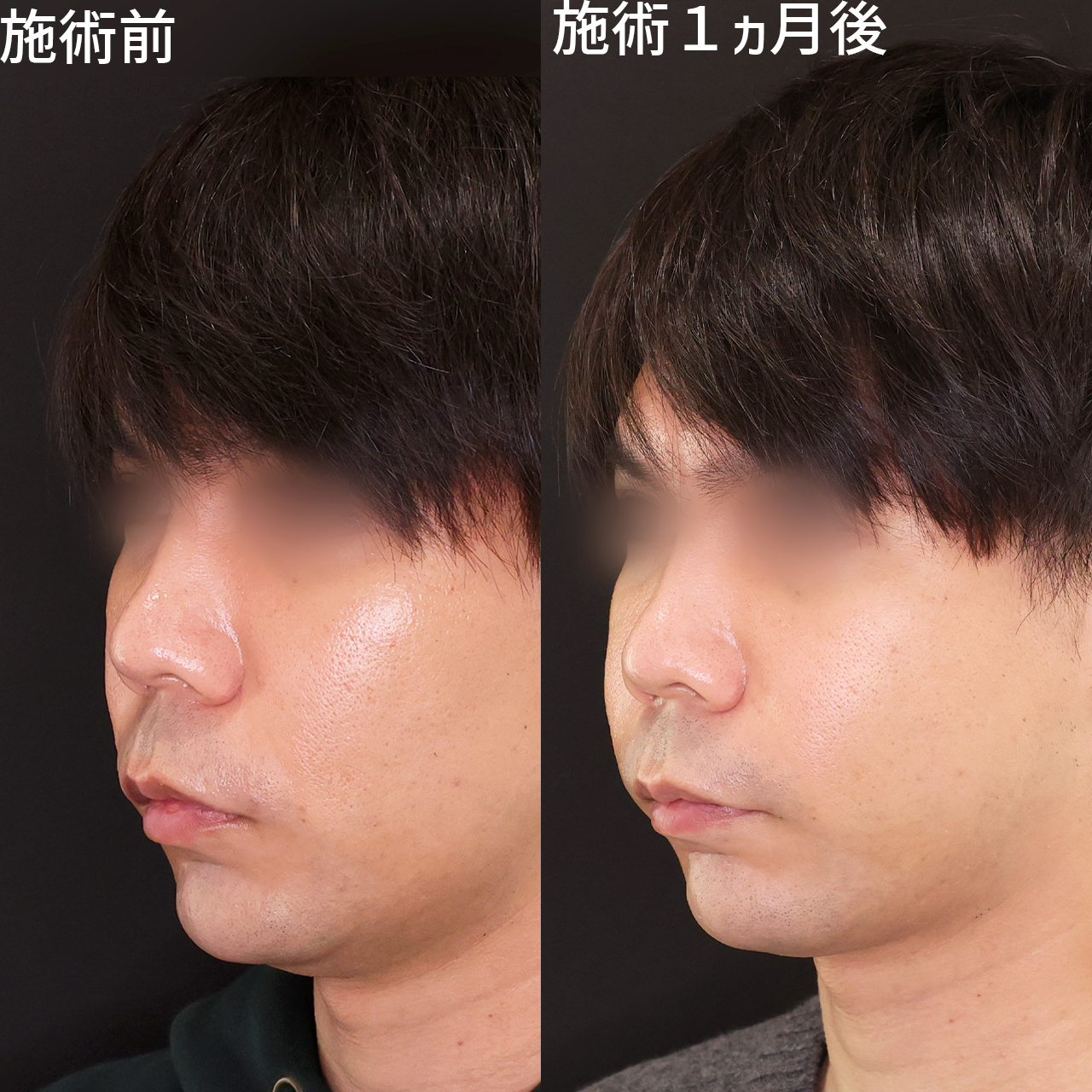 鼻翼基部プロテーゼで半永久的＆安全に鼻翼基部の凹みを改善。男性のほうれい線改善