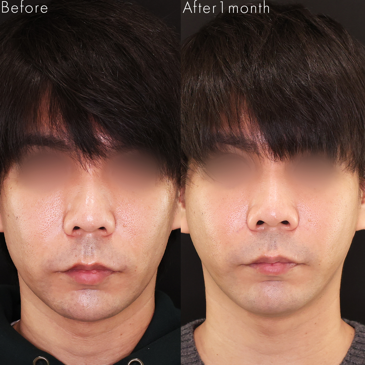 貴族手術（鼻翼基部プロテーゼ・脂肪注入・粉砕肋軟骨移植）の症例写真 施術前後 