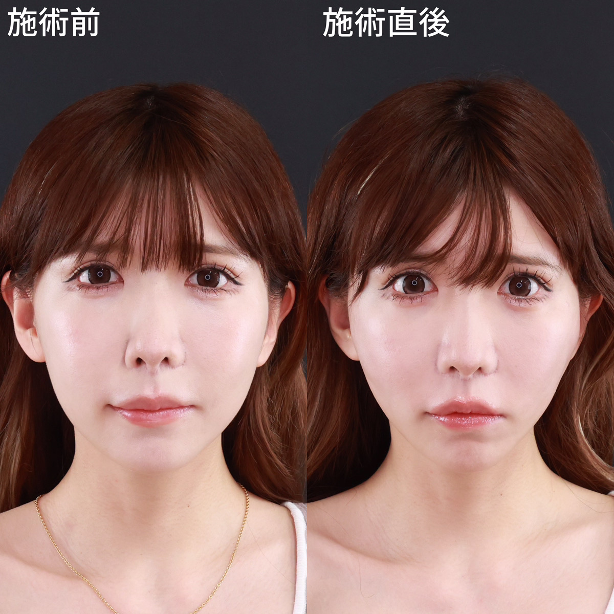 腫れにくく施術直後から小顔になるDr.森の小顔整形