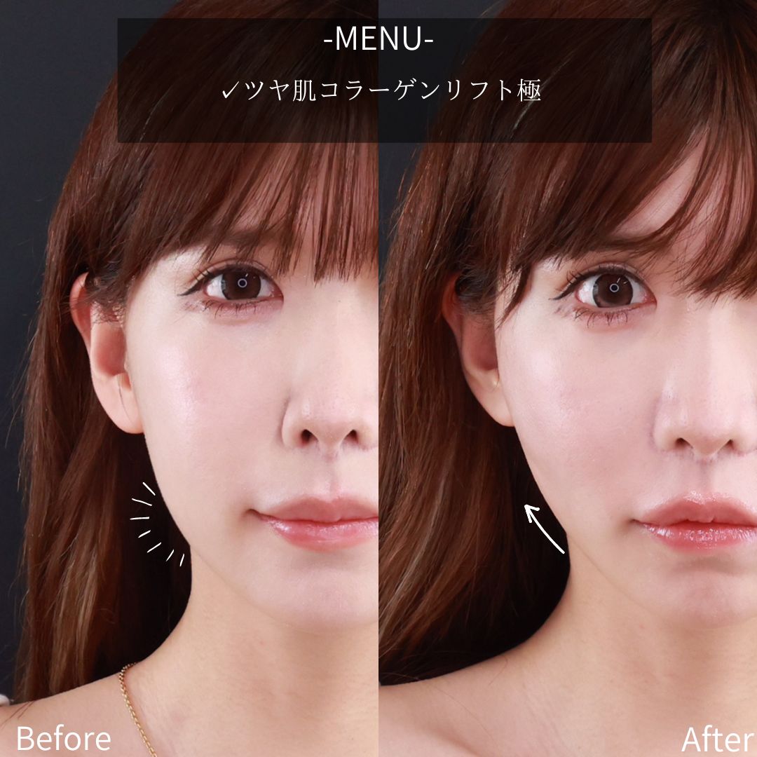 TAC式 ツヤ肌コラーゲンリフト®/小顔整形｜パーフェクトフェイスラインの症例写真 施術前後 