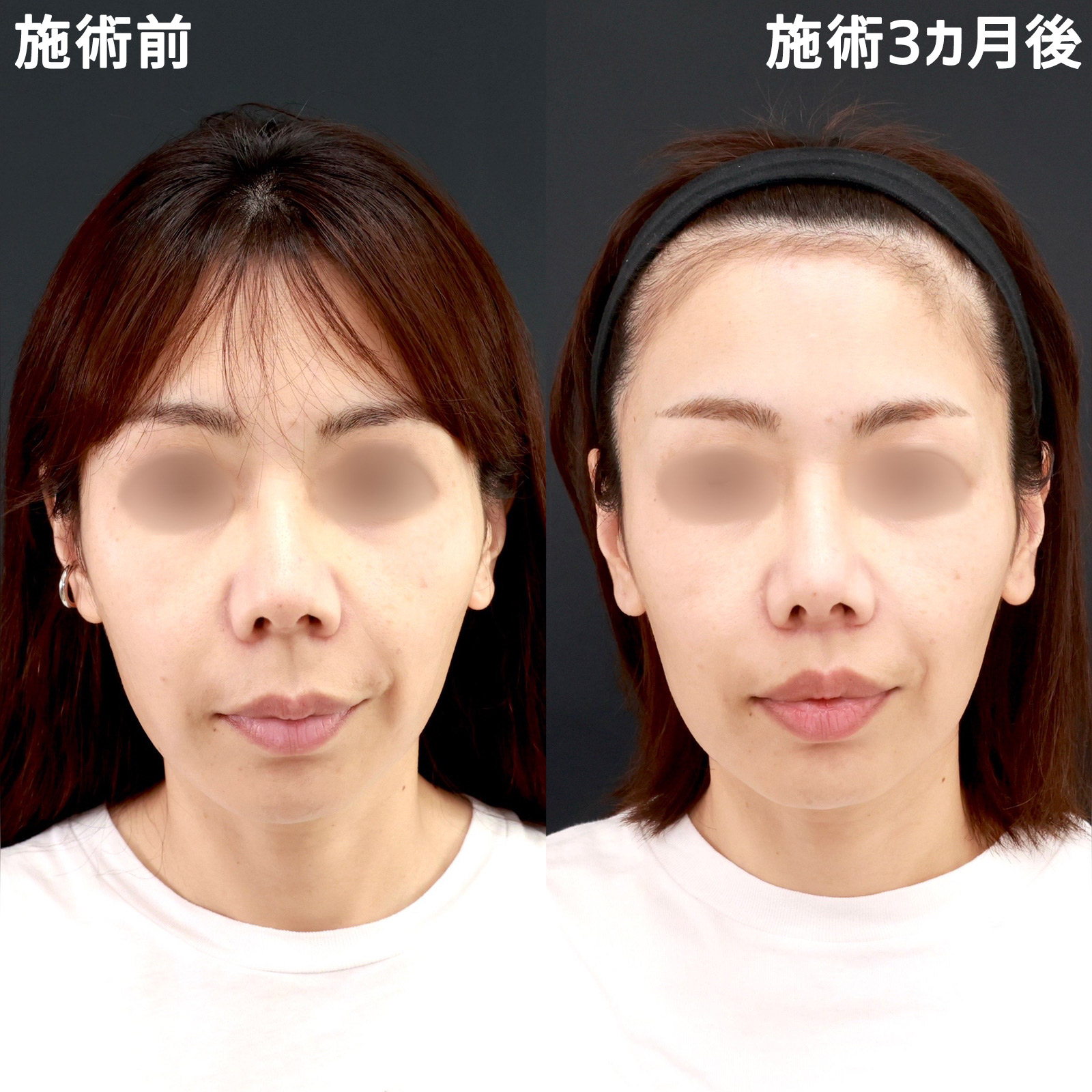 人中短縮術(リップリフト)・外側人中短縮術の症例写真 施術前後 