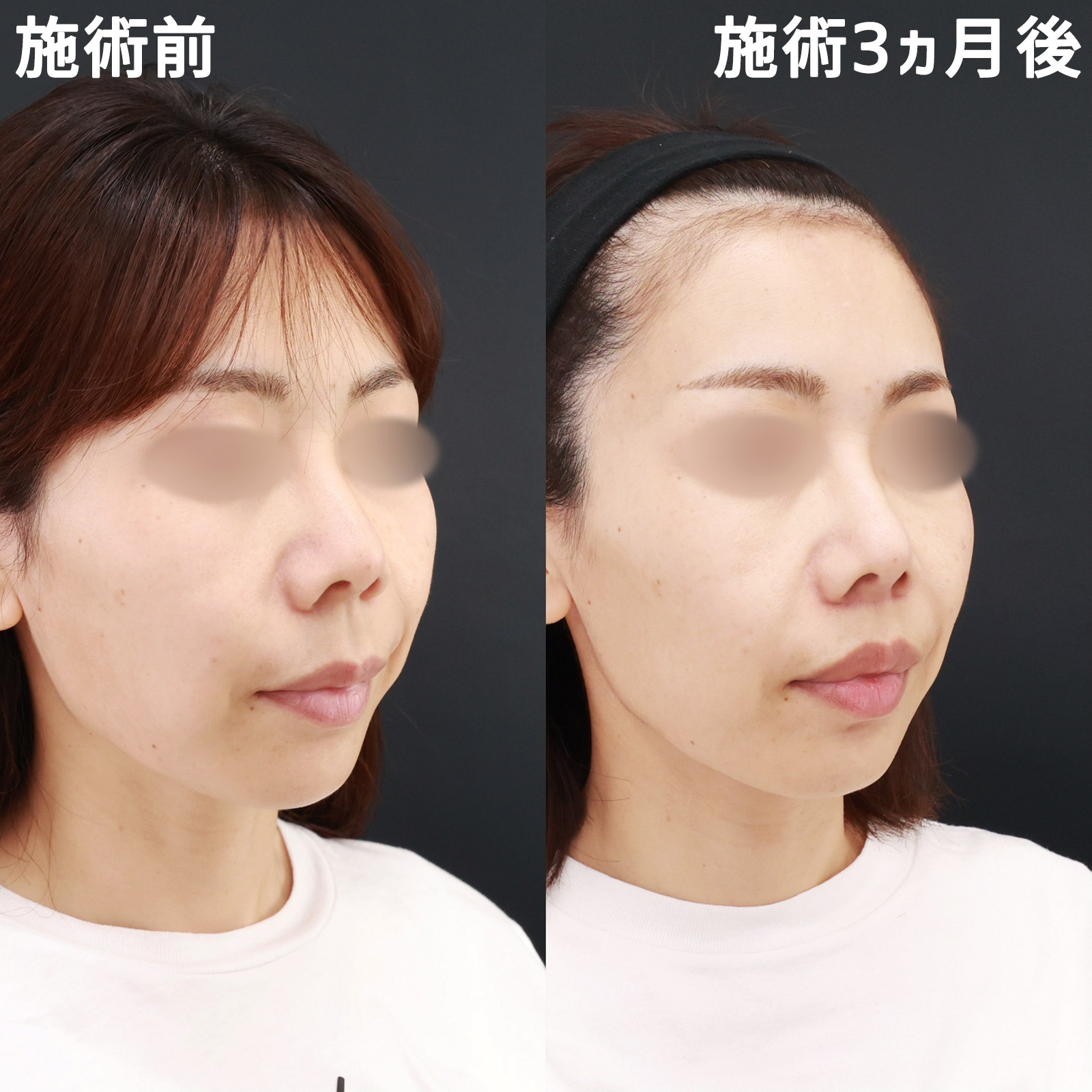 人中短縮術(リップリフト)・外側人中短縮術の症例写真 施術前後 