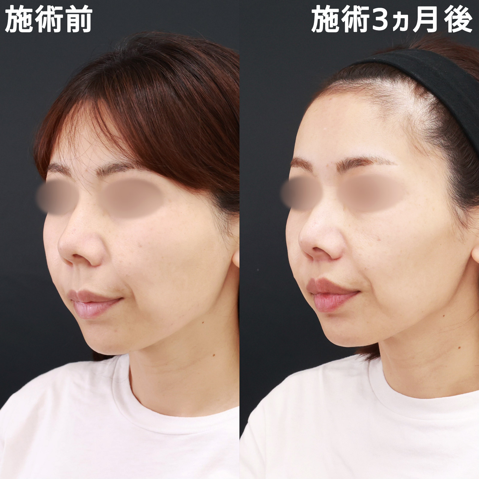 人中短縮術(リップリフト)・外側人中短縮術の症例写真 施術前後 